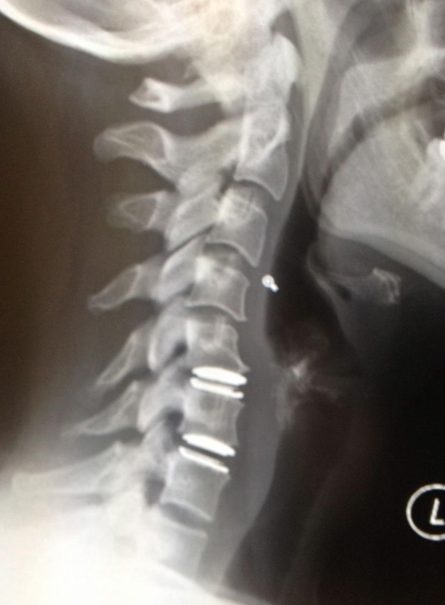 Cervical Disc Replacement Zaher Dannawi